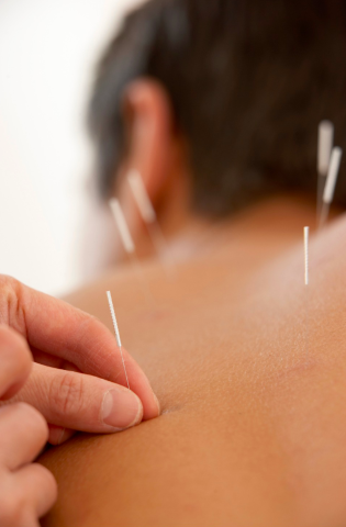 Acupunctura